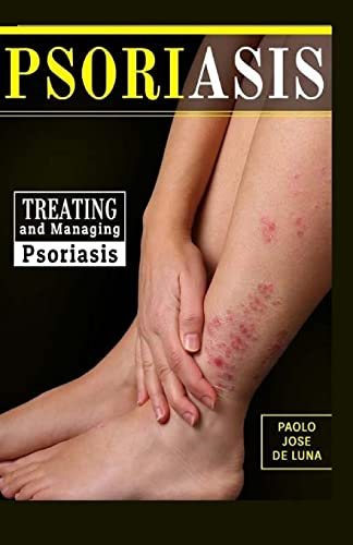 Psoriasis: Treating and Managing Psoriasis