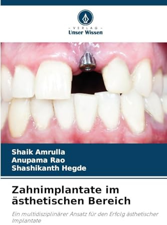Zahnimplantate im ästhetischen Bereich: Ein multidisziplinärer Ansatz für den Erfolg ästhetischer Implantate
