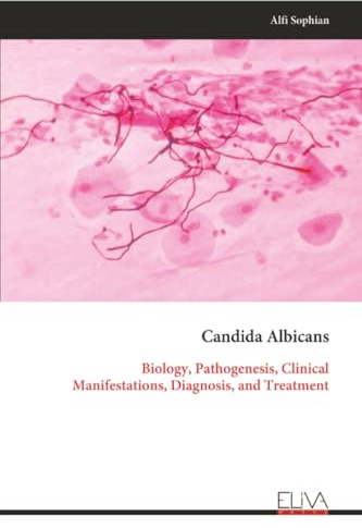 Candida Albicans: Biology, Pathogenesis, Clinical Manifestations, Diagnosis, and Treatment