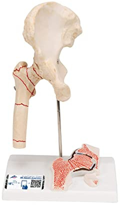 3B Scientific® Hüftgelenkmodell – Menschliche Hüftanatomie mit Oberschenkelbruch & Veränderungen durch Arthrose, Langlebiges PVC + Smart Anatomy App (5 Jahre Garantie)