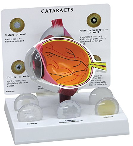 GPI Anatomicals W47852 Auge Modell Katarakt, grauer Star