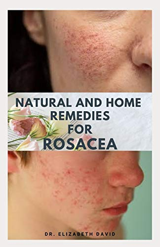 NATURAL AND HOME REMEDIES FOR ROSACEA: A Self Help Guide To Completely Prevent and Treat Rosacea