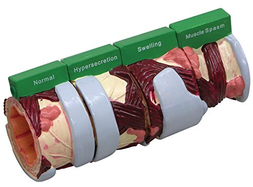 GPI Anatomicals W33362 Bronchie 4 Stadien Modell