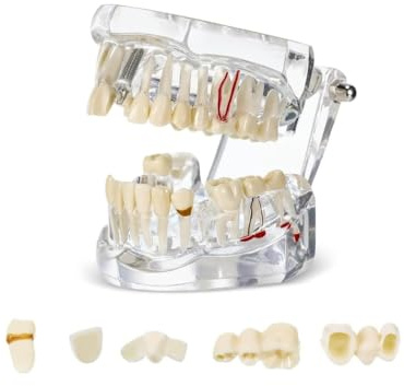 UIGJIOG Modello di Denti Trasparente Modello di Malattie Dentali Typodont Dentale Modello di Denti per Impianti con Denti Rimovibili Dimostrazione Standard del Dente per Dentisti